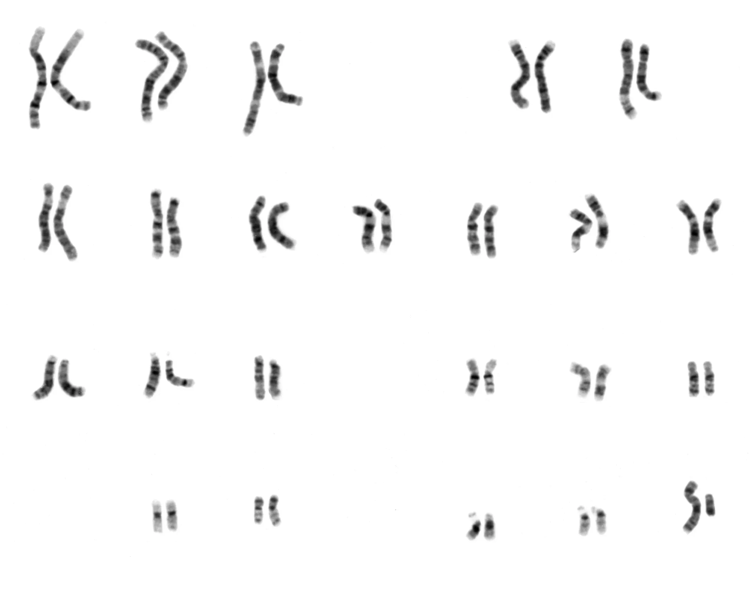 Karyotype image showing human chromosomes arranged in pairs, totaling 46 chromosomes in a standard layout.